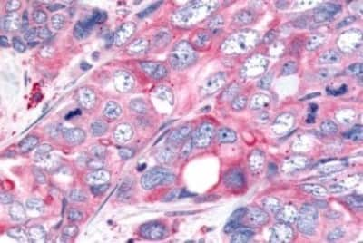 Immunohistochemistry-Paraffin: Wnt-8a Antibody [NBP3-14523] - Immunohistochemistry of formalin-fixed, paraffin-embedded human colon carcinoma after heat-induced antigen retrieval.