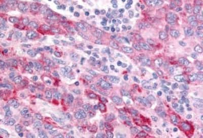 Immunohistochemistry-Paraffin: Wnt-8a Antibody [NBP3-14523] - Immunohistochemistry of formalin-fixed, paraffin-embedded human lung, non-small cell carcinoma, after heat-induced antigen retrieval.