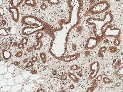 Immunohistochemistry: Wnt3 Antibody [NBP3-18245] - Immunohistochemistry analysis using Rabbit Anti-Wnt3 Polyclonal Antibody (NBP3-18245). Tissue: Breast. Species: Human. Fixation: Formalin Fixed Paraffin-Embedded. Primary Antibody: Rabbit Anti-Wnt3 Polyclonal Antibody (NBP3-18245) at 1:50 for 30 min at RT. Counterstain: Hematoxylin. Magnification: 10X. HRP-DAB Detection.