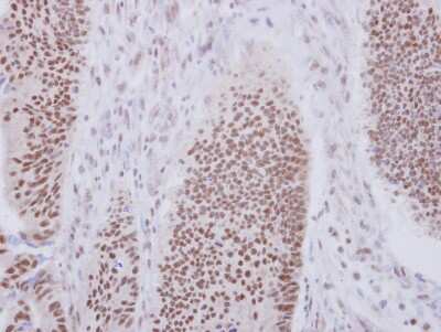 Immunohistochemistry-Paraffin: XAB2 Antibody [NBP2-20916] - Immunohistochemical analysis of paraffin-embedded Colon ca, using antibody at 1:250 dilution.