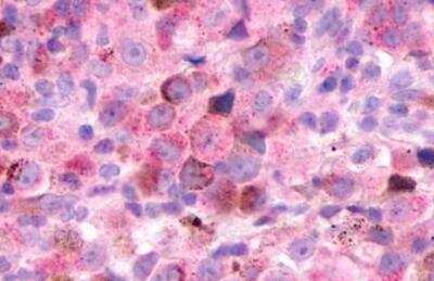 Immunohistochemistry-Paraffin: XCR1/CCXCR1 Antibody [NLS156] - Skin, Malignant Melanoma