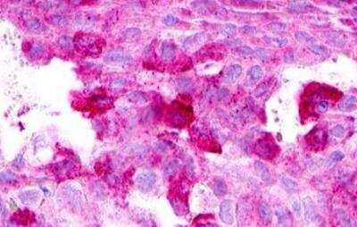 Immunohistochemistry-Paraffin: XCR1/CCXCR1 Antibody [NLS156] - Ovary, carcinoma