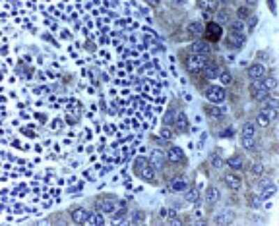 Immunohistochemistry-Paraffin: XIAP Antibody - Unpurified [NB100-56184] - Analysis of XIAP in formalin-fixed, paraffin-embedded human esophageal carcinoma using this antibody at 1:2000. Hematoxylin-eosin counterstain.