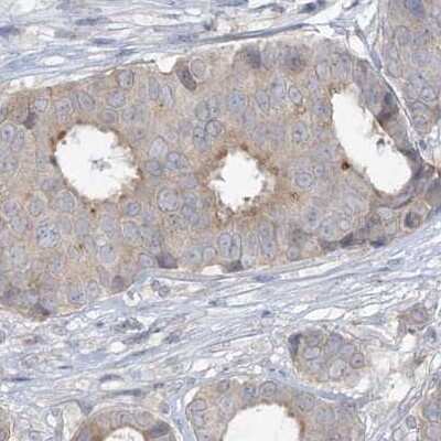 Immunohistochemistry-Paraffin: XKR3 Antibody [NBP2-33987] - Staining of breast cancer.