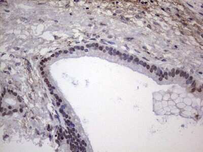 Immunohistochemistry: XLF Antibody (1B5) [NBP2-46163] - Analysis of Carcinoma of Human pancreas tissue.