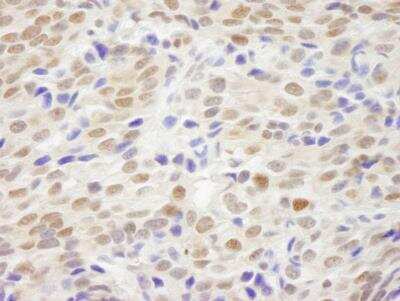 Immunohistochemistry-Paraffin: XLF Antibody [NB100-2258] - Section of human breast carcinoma. Antibody: Affinity purified rabbit anti- XLF used at a dilution of 1:200 (1ug/ml). Detection: DAB