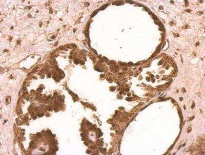 Immunohistochemistry-Paraffin: XLF Antibody [NBP1-31288] - Ovarian carcinoma. 