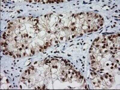 Immunohistochemistry: XLF Antibody (OTI3D6) - Azide and BSA Free [NBP2-74876] - Staining of paraffin-embedded Adenocarcinoma of Human ovary tissue using anti-XLF mouse monoclonal antibody.