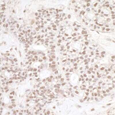 Immunohistochemistry-Paraffin: XPB Antibody [NB100-61059] - Detection of human ERCC3 by immunohistochemistry. Sample: FFPE section of human breast carcinoma. Antibody: Affinity purified rabbit anti-ERCC3 (NB100-61059). Detection: DAB