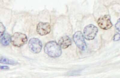 Immunohistochemistry-Paraffin: XPF Antibody [NB100-60679] - Human prostate carcinoma. Antibody: Affinity purified rabbit anti- XPF/ERCC4 used at a dilution of 1:200 (1ug/ml). Detection: DAB