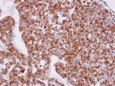 Immunohistochemistry-Paraffin: XPR1 Antibody [NBP1-31083] - Paraffin-embedded PITUITARY GLAND TUMOR, using antibody at 1:100 dilution.