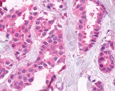 Immunohistochemistry-Paraffin: XPR1 Antibody [NBP2-29487] - Analysis of anti-XPR1 antibody with human breast, carcinoma.