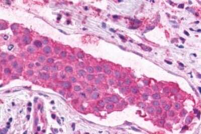 Immunohistochemistry-Paraffin: XPR1 Antibody [NBP2-29487] - Anti-XPR1 antibody IHC of human Breast, Carcinoma. Immunohistochemistry of formalin-fixed, paraffin-embedded tissue after heat-induced antigen retrieval.
