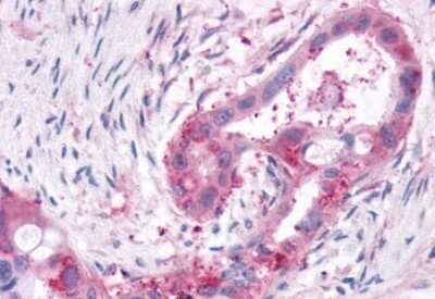 Immunohistochemistry-Paraffin: XPR1 Antibody [NBP2-29487] - Anti-XPR1 antibody IHC of human Pancreas, Carcinoma. Immunohistochemistry of formalin-fixed, paraffin-embedded tissue after heat-induced antigen retrieval.