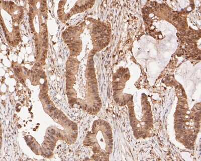 Immunohistochemistry-Paraffin: XRCC1 Antibody (JA11-47) [NBP2-66790] - Immunohistochemical analysis of paraffin-embedded human colon cancer tissue using anti- XRCC1 antibody. Counter stained with hematoxylin.