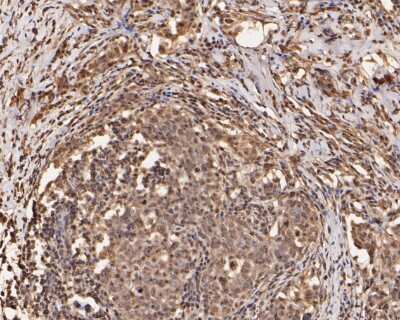 Immunohistochemistry-Paraffin: XRCC1 Antibody (JA11-47) [NBP2-66790] - Immunohistochemical analysis of paraffin-embedded human breast infiltrating duct carcinoma tissue using anti- XRCC1 antibody. Counter stained with hematoxylin.