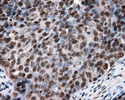 Immunohistochemistry: XRCC1 Antibody (OTI2F8) - Azide and BSA Free [NBP2-74891] - Staining of paraffin-embedded Adenocarcinoma of ovary tissue using anti-XRCC1 mouse monoclonal antibody.