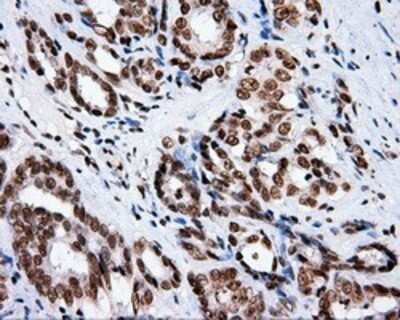 Immunohistochemistry: XRCC1 Antibody (OTI2F8) - Azide and BSA Free [NBP2-74891] - Staining of paraffin-embedded Carcinoma of prostate tissue using anti-XRCC1 mouse monoclonal antibody.