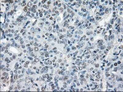 Immunohistochemistry: XRCC4 Antibody (OTI4H9) - Azide and BSA Free [NBP2-74896] - Staining of paraffin-embedded Adenocarcinoma of endometrium tissue using anti-XRCC4 mouse monoclonal antibody.