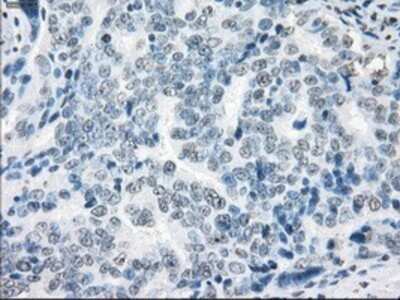 Immunohistochemistry: XRCC4 Antibody (OTI4H9) - Azide and BSA Free [NBP2-74896] - Staining of paraffin-embedded Adenocarcinoma of ovary tissue using anti-XRCC4 mouse monoclonal antibody.