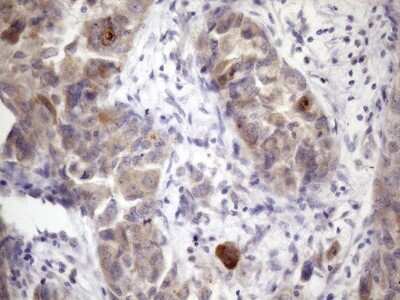 Immunohistochemistry: XRCC6BP1 Antibody (5F3) [NBP2-46374] - Analysis of Adenocarcinoma of Human endometrium tissue. (Heat-induced epitope retrieval by 1mM EDTA in 10mM Tris buffer (pH8.5) at 120C for 3 min)