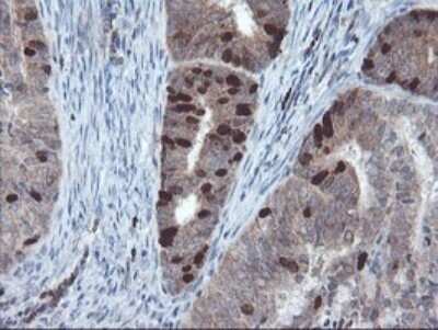Immunohistochemistry: XTP4 Antibody (OTI2D5) - Azide and BSA Free [NBP2-74904] - Analysis of Adenocarcinoma of Human endometrium tissue.