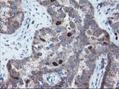 Immunohistochemistry: XTP4 Antibody (OTI2D5) - Azide and BSA Free [NBP2-74904] - Analysis of Adenocarcinoma of Human ovary tissue.