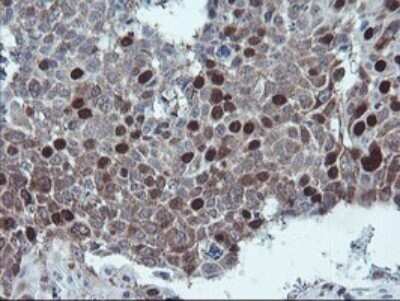 Immunohistochemistry: XTP4 Antibody (OTI2D5) - Azide and BSA Free [NBP2-74904] - Analysis of Carcinoma of Human lung tissue.