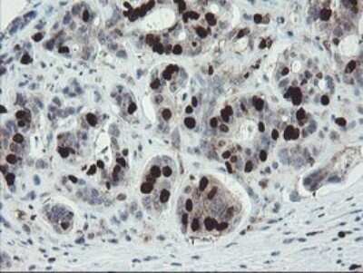 Immunohistochemistry: XTP4 Antibody (OTI2D5) - Azide and BSA Free [NBP2-74904] - Analysis of Carcinoma of Human pancreas tissue.