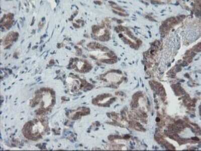 Immunohistochemistry: XTP4 Antibody (OTI2D5) - Azide and BSA Free [NBP2-74904] - Analysis of Carcinoma of Human prostate tissue.