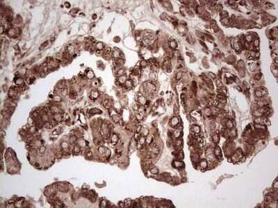 Immunohistochemistry: YB1 Antibody (OTI7B4) - Azide and BSA Free [NBP2-74905] - Analysis of Adenocarcinoma of Human ovary tissue. (Heat-induced epitope retrieval by 1 mM EDTA in 10mM Tris, pH8.5, 120C for 3min)
