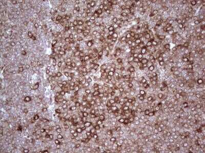Immunohistochemistry: YB1 Antibody (OTI7B4) - Azide and BSA Free [NBP2-74905] - Analysis of Human lymphoma tissue. (Heat-induced epitope retrieval by 1 mM EDTA in 10mM Tris, pH8.5, 120C for 3min)