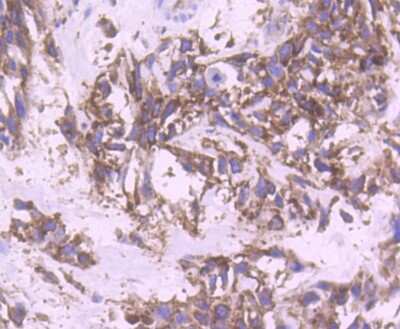 Immunohistochemistry-Paraffin: YB1 Antibody (ST0432) [NBP2-67491] - Analysis of paraffin-embedded human breast carcinoma tissue using anti-YB1 antibody. Counter stained with hematoxylin.