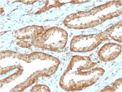 Immunohistochemistry-Paraffin: YB1 Antibody (YBX1/2430) [NBP3-08774] - Formalin-fixed, paraffin-embedded human Prostate Carcinoma stained with YB1 Mouse Monoclonal Antibody (YB1/2430)