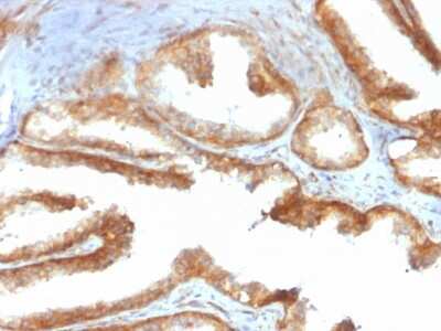 Immunohistochemistry-Paraffin: YB1 Antibody (rYBX1/2430) [NBP3-07461] - Formalin-fixed, paraffin-embedded human Prostate Carcinoma stained with YB1 Mouse Recombinant Monoclonal Antibody (rYB1/2430).