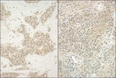 <b>Independent Antibodies Validation and Biological Strategies Validation.</b>Immunohistochemistry-Paraffin: YY1 Antibody [NBP1-46218] - Section of human breast carcinoma (left) and mouse teratoma (right). Antibody: Affinity purified rabbit anti-YY1 used at a dilution of 1:200 (1ug/ml). Detection: DAB