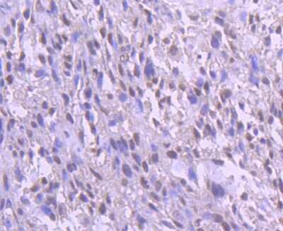 Immunohistochemistry-Paraffin: YY1 Antibody (SY29-01) [NBP2-67391] - Analysis of paraffin-embedded human breast carcinoma tissue using anti-YY1 antibody. Counter stained with hematoxylin.