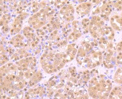 Immunohistochemistry-Paraffin: ZBTB48 Antibody [NBP2-75720] - Analysis of paraffin-embedded human liver cancer tissue using anti-ZBTB48 antibody. Counter stained with hematoxylin.