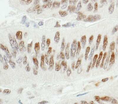 <b>Independent Antibodies Validation and Biological Strategies Validation.</b>Immunohistochemistry-Paraffin: ZBTB7A/Pokemon Antibody [NB100-762] - Section of human colon carcinoma. Antibody: Affinity purified rabbit anti- ZBTB7/FBI-1 used at a dilution of 1:200 (1ug/ml). Detection: DAB