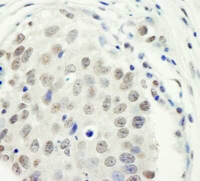 <b>Independent Antibodies Validation. </b>Immunohistochemistry: ZC3H11A Antibody [NB100-74651] - Detection of Human ZC3H11A by Immunohistochemistry. Sample: FFPE section of human ovarian carcinoma. Antibody: Affinity purified rabbit anti-ZC3H11A at a dilution of 1:100.