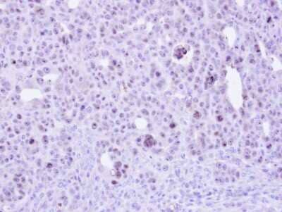 Immunohistochemistry-Paraffin: ZC3H8 Antibody [NBP1-32522] - Paraffin-embedded NCIN87 xenograft, using antibody at 1:500 dilution.