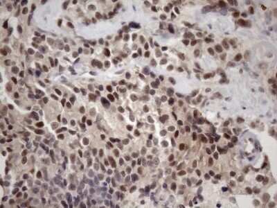 Immunohistochemistry: ZC3H8 Antibody (OTI4H5) - Azide and BSA Free [NBP2-74908] - Analysis of Adenocarcinoma of Human breast tissue. (Heat-induced epitope retrieval by 1mM EDTA in 10mM Tris buffer (pH8.5) at 120C for 3 min)