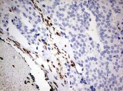 Immunohistochemistry: ZEB1 Antibody (OTI3G6) - Azide and BSA Free [NBP2-74910] - Analysis of Adenocarcinoma of Human breast tissue. (Heat-induced epitope retrieval by 10mM citric buffer, pH6.0, 120C for 3min)