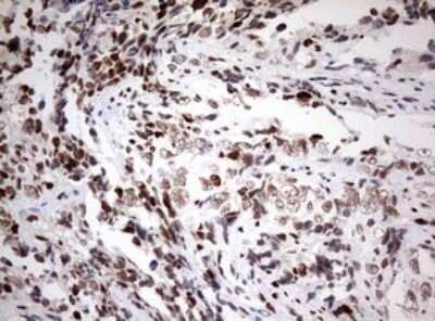 Immunohistochemistry: ZEB1 Antibody (OTI3G6) - Azide and BSA Free [NBP2-74910] - Analysis of Adenocarcinoma of Human endometrium tissue. (Heat-induced epitope retrieval by 10mM citric buffer, pH6.0, 120C for 3min)