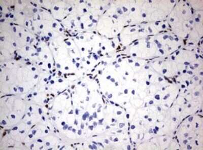 Immunohistochemistry: ZEB1 Antibody (OTI3G6) - Azide and BSA Free [NBP2-74910] - Analysis of Carcinoma of Human kidney tissue. (Heat-induced epitope retrieval by 10mM citric buffer, pH6.0, 120C for 3min)