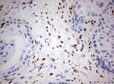 Immunohistochemistry: ZEB1 Antibody (OTI3G6) - Azide and BSA Free [NBP2-74910] - Analysis of Carcinoma of Human lung tissue. (Heat-induced epitope retrieval by 10mM citric buffer, pH6.0, 120C for 3min)