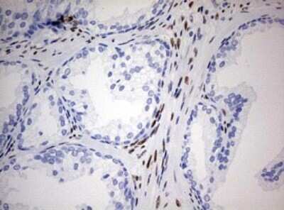 Immunohistochemistry: ZEB1 Antibody (OTI3G6) - Azide and BSA Free [NBP2-74910] - Analysis of Human prostate tissue. (Heat-induced epitope retrieval by 10mM citric buffer, pH6.0, 120C for 3min)