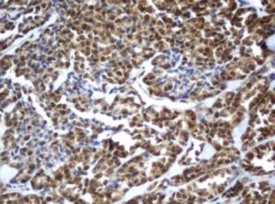 Immunohistochemistry: ZFAND5 Antibody (5H8) [NBP2-45422] - Analysis of Carcinoma of Human thyroid tissue. (Heat-induced epitope retrieval by 10mM citric buffer, pH6.0, 120C for 3min)