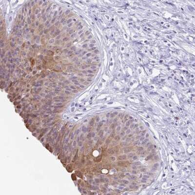 Immunohistochemistry: ZFP64 Antibody [NBP2-38852] - Staining of human urinary bladder shows moderate cytoplasmic and nuclear positivity in urothelial cells.