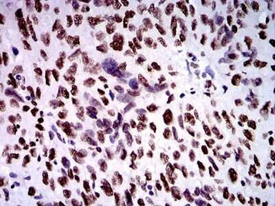 Immunohistochemistry: ZFP91 Antibody (7G11H2) [NBP2-61854] - Analysis of paraffin-embedded ovarian cancer tissues using ZFP91 mouse mAb with DAB staining.